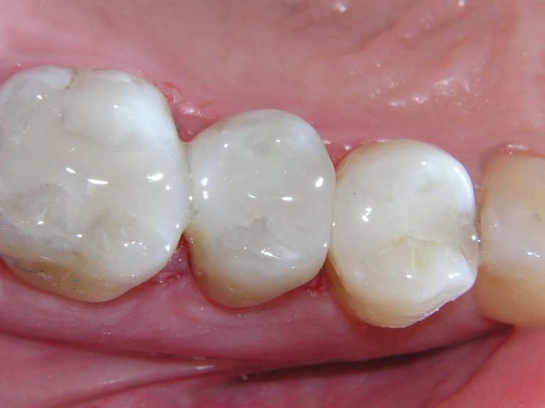 Teeth Composite Resins/White Fillings in Burlington, IA Massner Dentistry