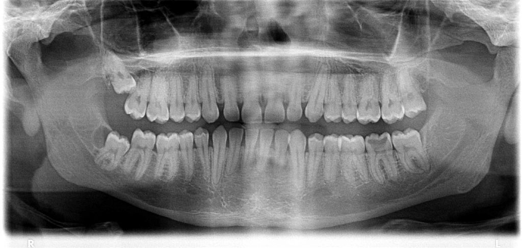 Panoramic teeth x-ray